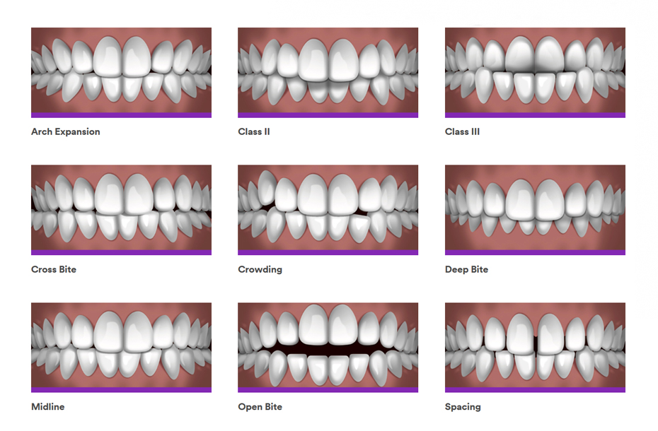 Invisalign (Clear Aligner) Braces Before and After: 3M Clarity